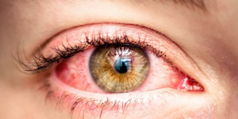 آیا مواد شیمیایی به بینایی صدمه می‌زند؟
